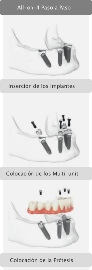 Colocacin de la Prtesis Colocacin de los Multi-unit Insercin de los Implantes All-on-4 Paso a Paso